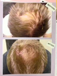 before and after LLLT hair replacement treatment