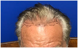 Hair Restoration Case Study Patient 1