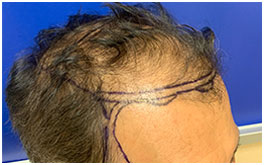 Hair Restoration Case Study Patient 2
