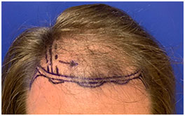 Hair Restoration Case Study Patient 3
