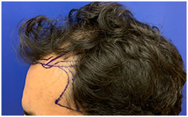 Hair Restoration Case Study Patient 4