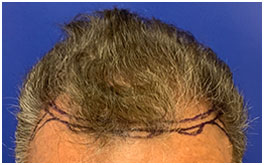 Hair Restoration Case Study Patient 5