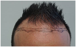 Hair Restoration Case Study Patient 6
