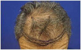 Hair Restoration Case Study Patient 8