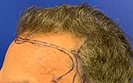 Hair Restoration Case Study Patient 10